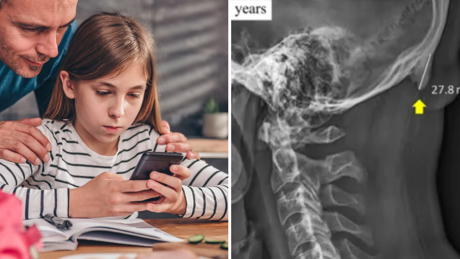 Can Smartphone Use Really Cause “Horns” to Grow on the Skull? What Science Actually Says